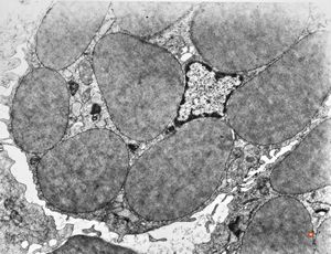 F,32y. | lymphadenopathy - clin. dysglobulinaemia F,32y. | lymphadenopathy - clin. dysglobulinaemia